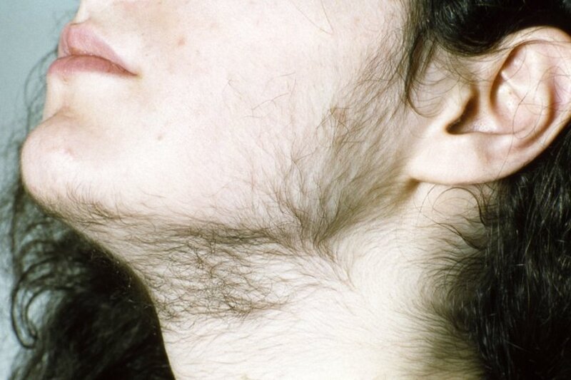 Hội chứng Cushing khiến lông ở núm vú phát triển mạnh