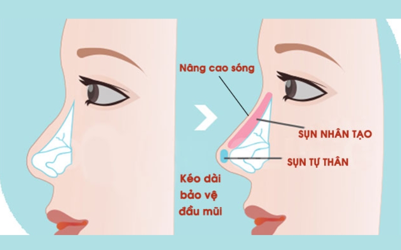 Kết hợp nâng cao sống mũi bằng sụn nhân tạo, bọc đầu mũi bằng sụn vành tai là phương pháp đem lại hiệu quả tối ưu