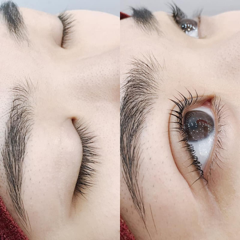 Sau 3 - 6 tháng, khi các mô cơ liên kết chặt chẽ với nhau nhưng mí mắt vẫn không đều thì cần chỉnh sửa cắt mí 