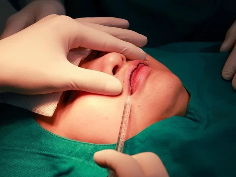 Phẫu thuật môi dày thành môi mỏng là cách hiệu quả để có đôi môi quyến rũ, cuốn hút