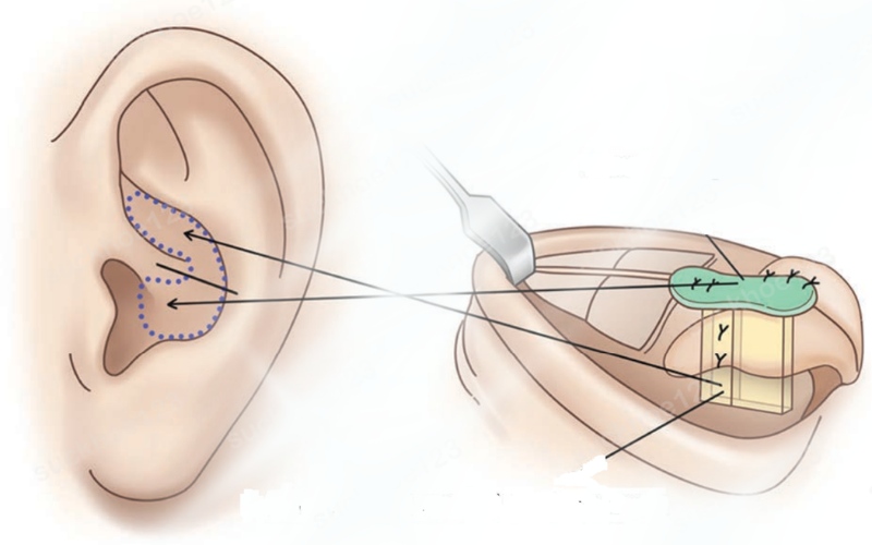 Lấy sụn tai nâng mũi hoàn toàn không gây ảnh hưởng gì đến sức khỏe và cấu trúc tai sau phẫu thuật