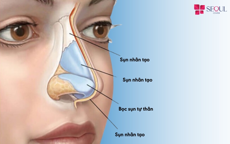Kết hợp sụn nhân tạo và sụn tự thân bọc đầu mũi để phòng tránh nguy cơ teo sụn trong nâng mũi hiệu quả