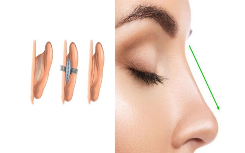 Nâng mũi bằng sụn tai sẽ teo ít hoặc nhiều tùy thuộc vào phương pháp đặt sụn, cơ địa khách hàng