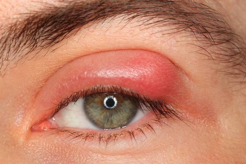 Vì vùng mí mắt sau khi cắt đã chịu một số tổn thương nên khi chỉnh sửa lại cẩn thực hiện chuẩn xác và tỉ mỉ