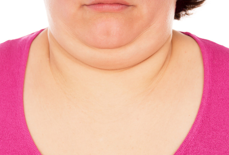 Mỡ mặt hầu hết do tình trạng tăng cân quá mức