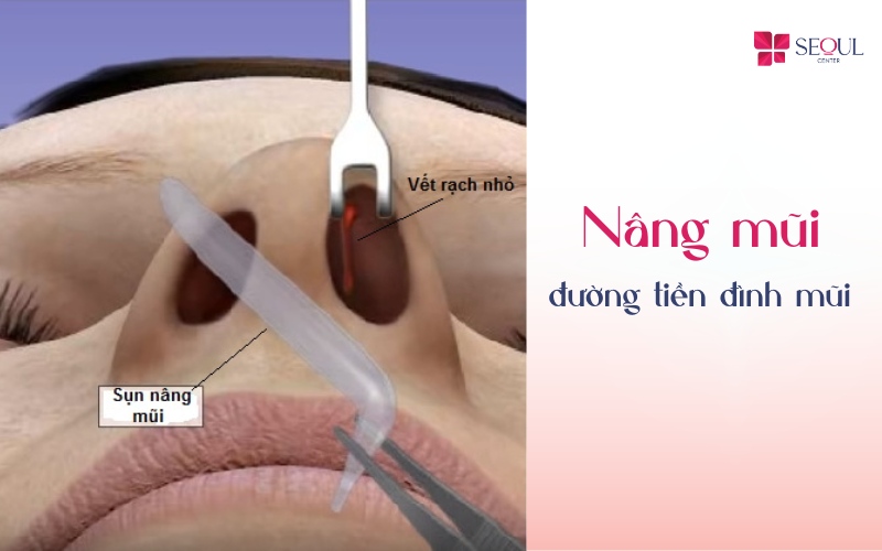 Nâng mũi qua đường tiền đình mũi là kỹ thuật mổ kín được ứng dụng trong phương pháp nâng mũi sụn nhân tạo