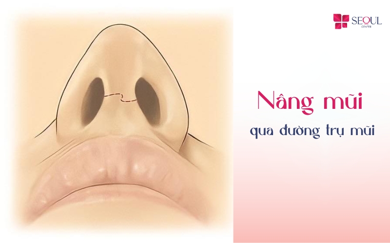 Nâng mũi qua đường trụ mũi là kỹ thuật mổ hở được ứng dụng rộng rãi trong các ca phẫu thuật nâng mũi