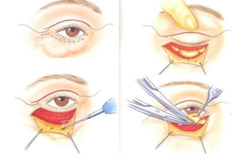 Xóa đường rãnh mắt bằng phẫu thuật là phương pháp triệt tiêu nếp nhăn, rãnh lệ hiệu quả vĩnh viễn