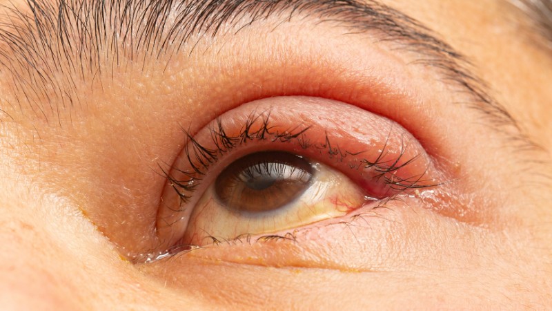 Sau tiểu phẫu mí mắt thường bị sưng và đau do tác động của dao kéo