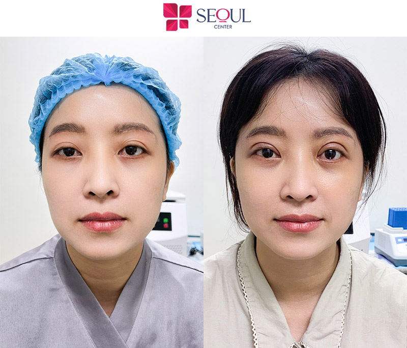 Hình ảnh before và after của khách sau khi cắt mí mắt Hàn Quốc tại thẩm mỹ viện Resolute Bay