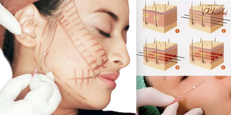 Căng da mặt là phương pháp an toàn không gây biến chứng nguy hiểm