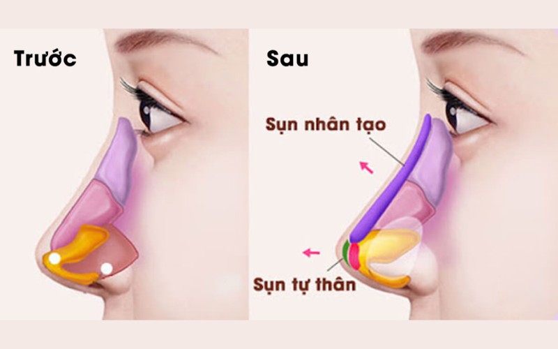 Nâng mũi bọc sụn tai sẽ dùng thêm sụn tự thân để bọc đầu mũi