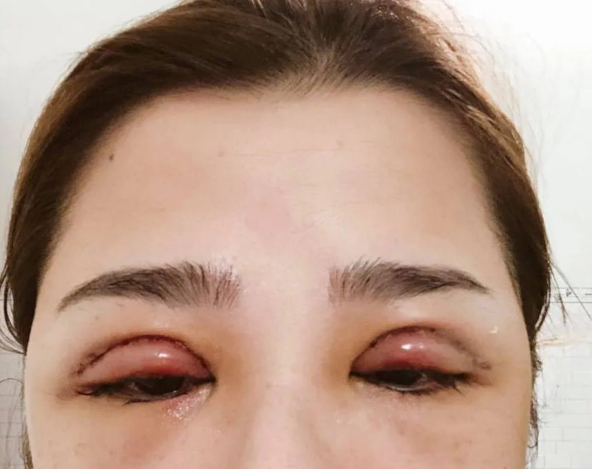 Tình trạng nhiễm trùng mắt xuất hiện do chăm sóc hậu phẫu không đúng cách