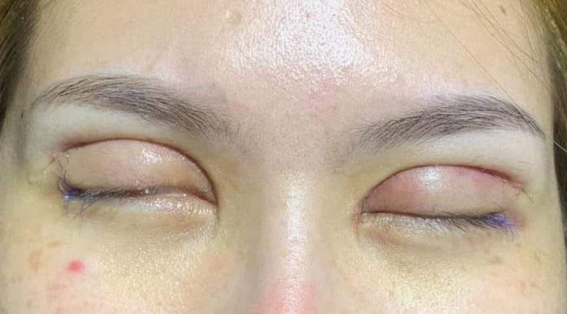Đôi mắt có nguy cơ bị sưng, đau nếu không có cách chăm sóc sau cắt mí phù hợp