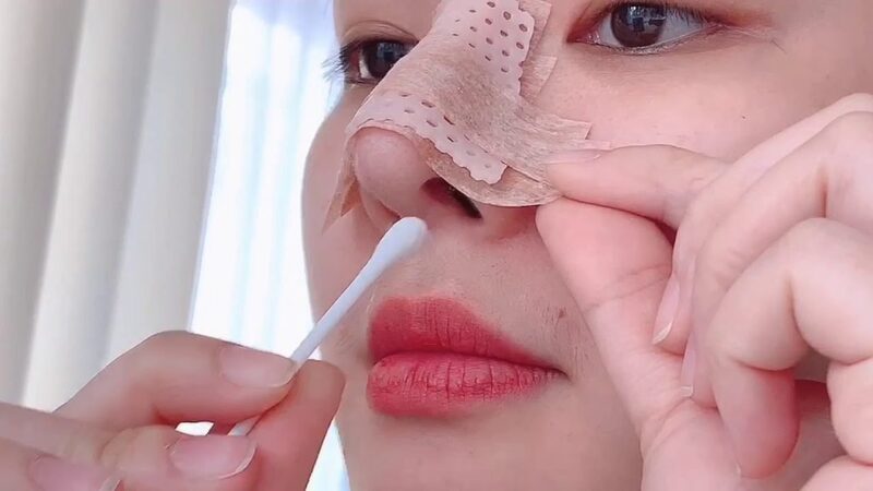 Vệ sinh vết thương nâng mũi đúng cách giúp phòng ngừa mụn 