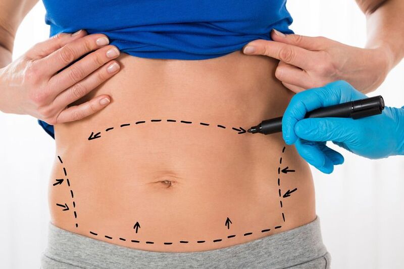 Hút mỡ bụng là phẫu thuật chỉ rạch một đường nhỏ trên da nên tỷ lệ để lại sẹo rất thấp