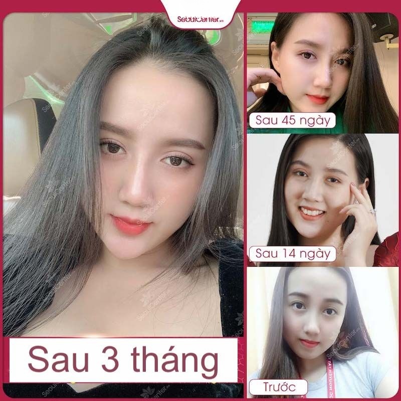 Hình ảnh trước và sau khi thực hiện nhấn mí mắt Thái Lan