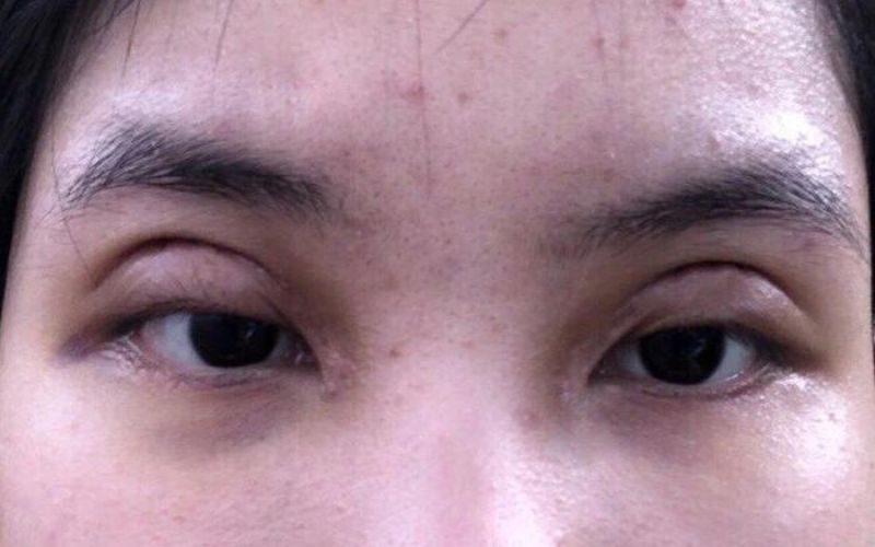 Không nên lạm dụng việc phẫu thuật để tránh tình trạng đôi mắt thiếu tự nhiên
