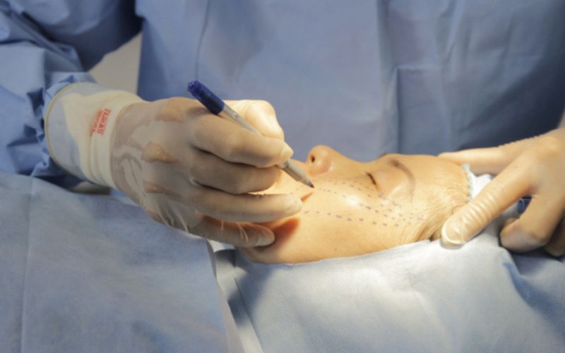 Các công nghệ căng da mặt không phẫu thuật được chứng minh an toàn, hạn chế xảy ra các biến chứng