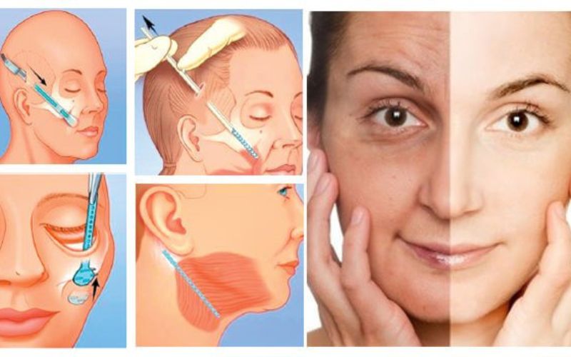 Phẫu thuật căng da mặt giúp loại bỏ nhiều khuyết điểm trên da