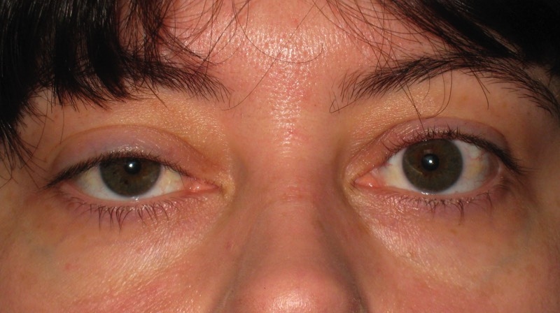 Nữ giới có mắt chênh lệch cao thấp đường tình duyên không suôn sẻ