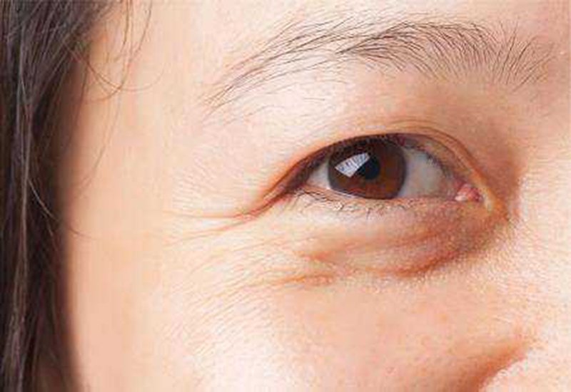 Cắt mí mắt cho người trung niên hoàn toàn có thể thực hiện mà không gây hại