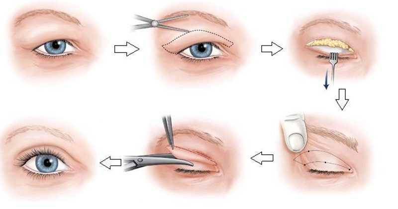 Quy trình diễn ra cắt mí mắt cho người trung niên cần chính xác và tỉ mỉ hơn
