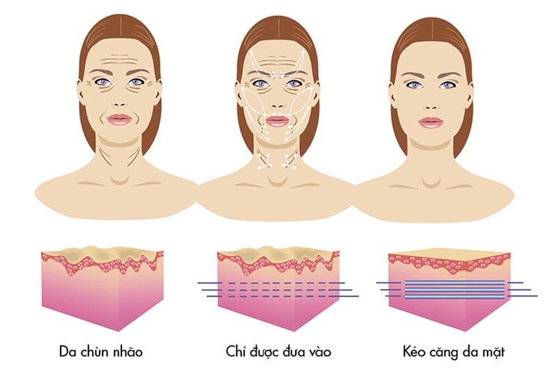 Phương pháp căng chỉ da mặt collagen được áp dụng phổ biến