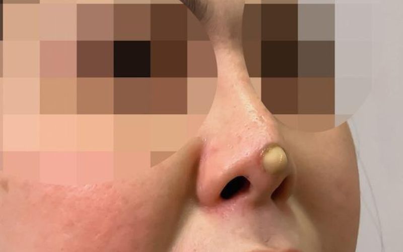 Nâng mũi quá cao làm cho đầu mũi bị thủng