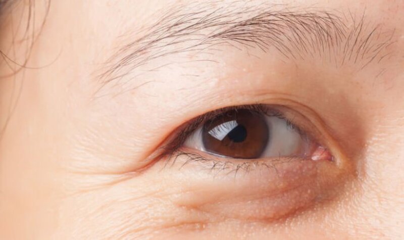Lão hóa da có thể gây bọng mắt trên da