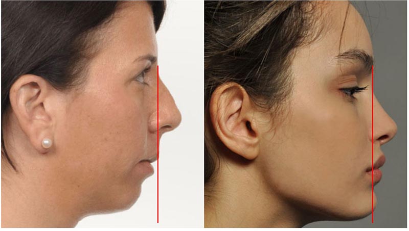 Bài tập tăng trưởng khuôn mặt phía trước giúp khắc phục tình trạng hàm móm, hàm nhô