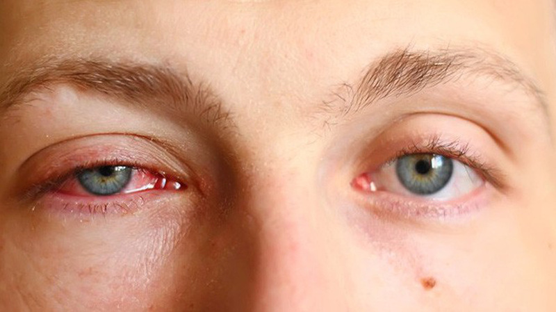Mắt bị sưng mí trên sau khi ngủ dậy có thể là do bạn ngủ không đủ giấc