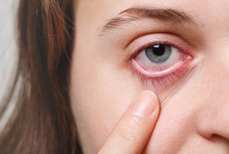 Mí mắt trên sưng sau khi ngủ dậy có thể bạn đang mắc phải bệnh lý về thận