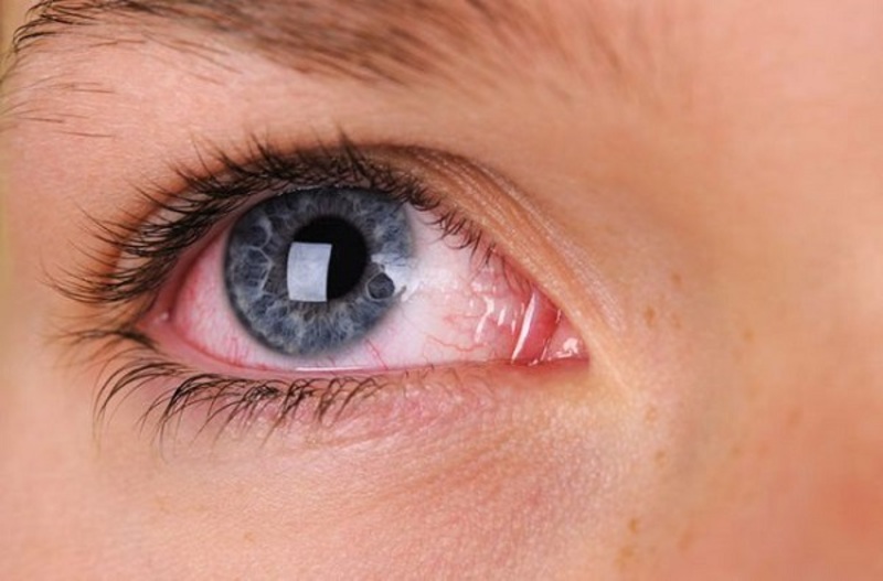 Sử dụng kính áp tròng thường xuyên mà không vệ sinh kỹ sẽ làm mắt sưng