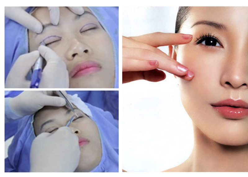Toàn bộ quy trình tiến hành cắt mí mắt full cần thực hiện theo chuẩn y khoa