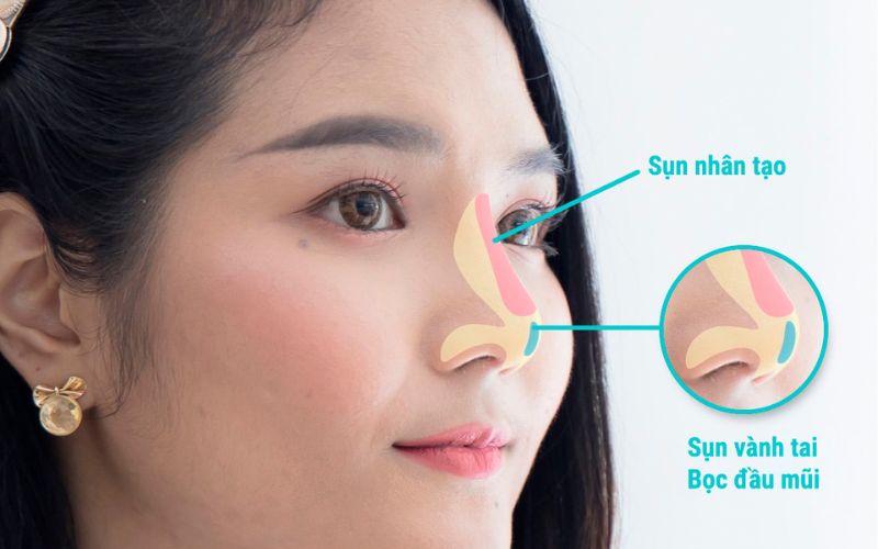 Phương pháp nâng mũi cấu trúc có thể xử lý hầu hết các khuyết điểm trên chiếc mũi