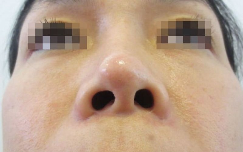 Nâng mũi không bọc đầu không khắc phục được mũi ngắn, mũi hếch, đầu mũi to…