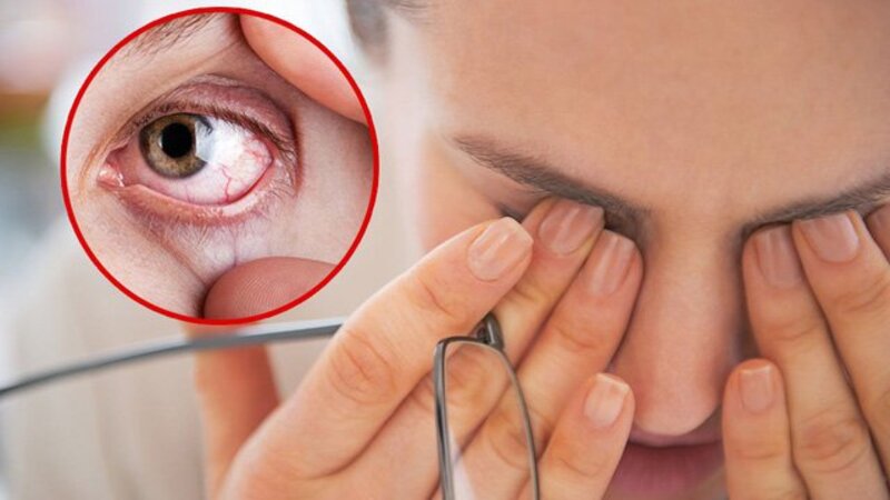Hội chứng khô mắt do nước mắt tạo ra không đủ để cấp ẩm cho giác mạc