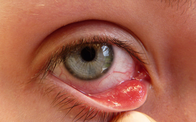 Viêm bờ mi là tình trạng nhiễm khuẩn với triệu chứng mắt khô, đỏ