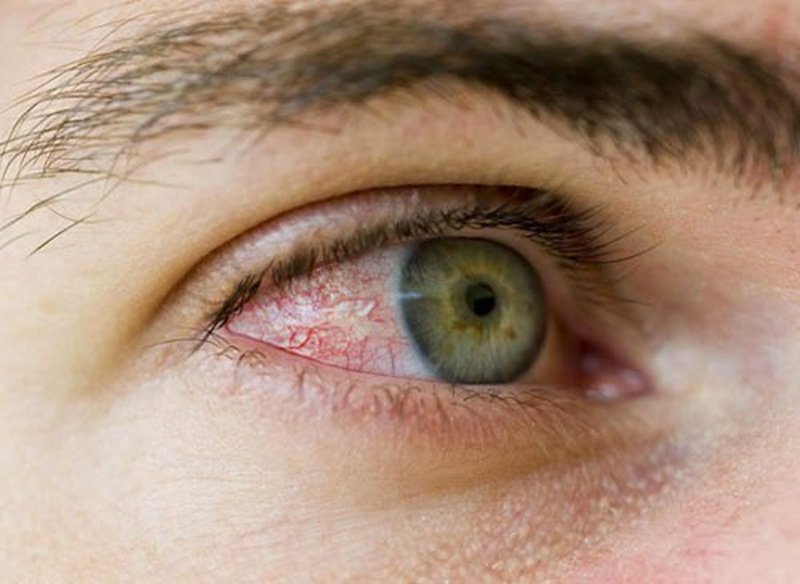 Viêm kết mạc có thể gặp ở 1 hay 2 bên mắt gây ngứa rất khó chịu