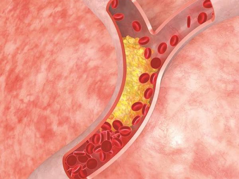 Tắc mạch do mỡ có thể xảy ra hậu hút mỡ bụng