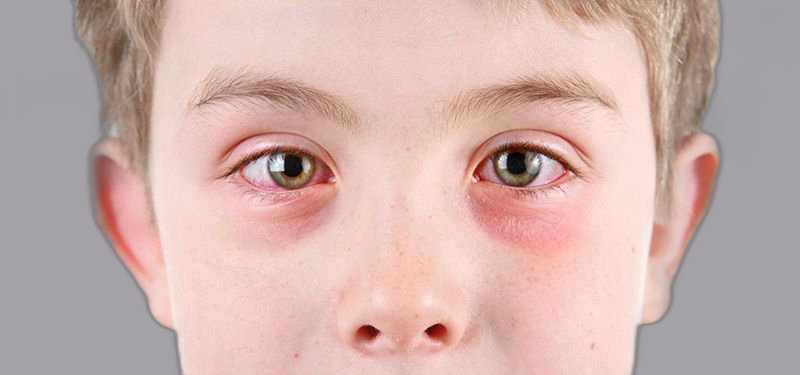 Mắt trẻ em rất nhạy cảm và dễ bị kích ứng