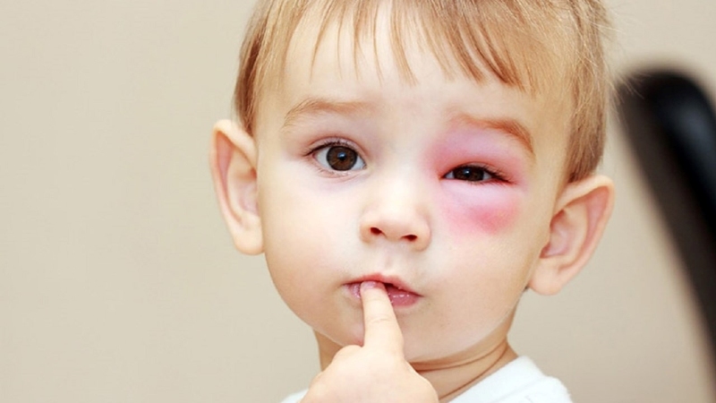 Virus gây rộp sinh dục và miệng (Herpes) có thể gây viêm giác mạc ở trẻ em