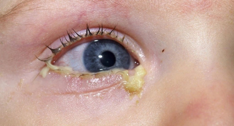 Viêm kết mạc ở trẻ em còn kèm theo tình trạng đóng mủ dày ở mắt