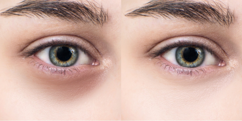 Massage mắt đúng cách giúp cải thiện tình trạng quầng thâm mắt