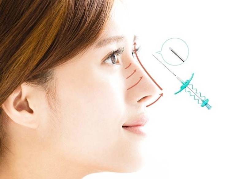 Phương pháp nâng mũi bằng chỉ thẩm mỹ Ultra V-lift giúp vết thương nhanh hồi phục