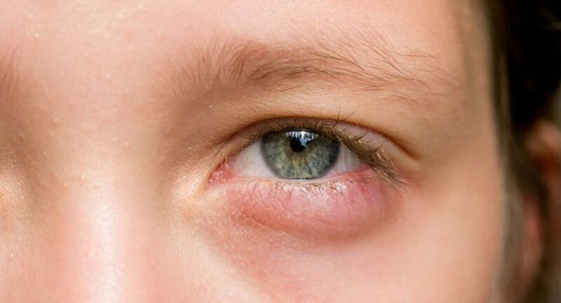 Đôi mắt sưng đỏ, mí sụp là triệu chứng điển hình của bệnh lý viêm mi mắt