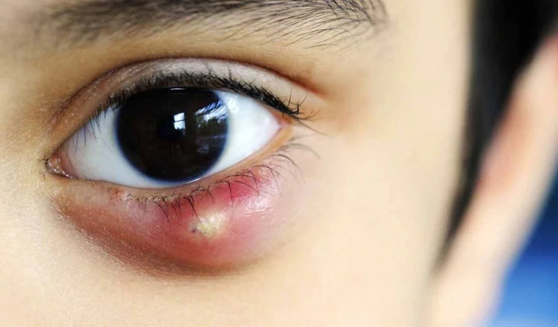 Chắp lẹo là nguyên nhân dẫn đến nhiễm trùng khiến mụn nhỏ trắng xuất hiện ở mi mắt
