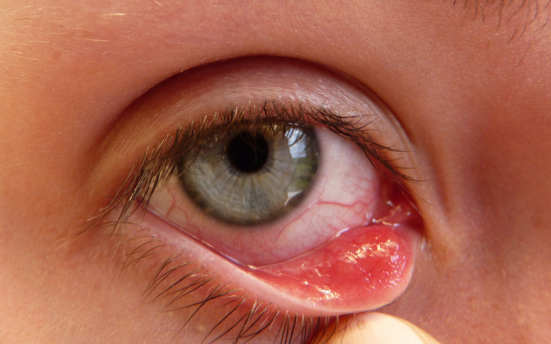 Viêm niêm mạc mắt có biểu hiện là nhiều nốt mụn trắng nhỏ li ti xuất hiện trên mí mắt