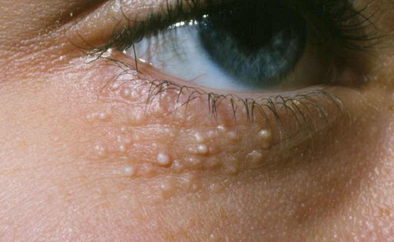 Các nốt mụn nhỏ trên mi mắt không gây nguy hiểm đến sức khỏe của bạn